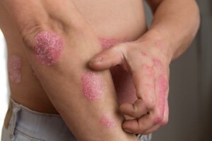 Psoriasis