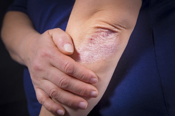Psoriasis