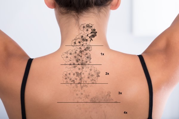 Laser Treatment