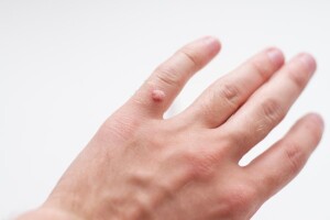 Warts