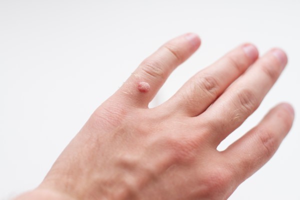 Warts