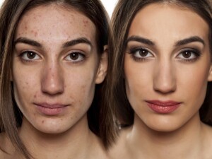 Dermatology