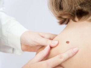Melanoma